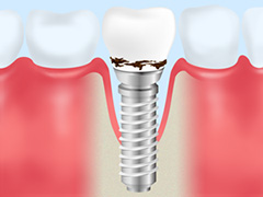 足立区の歯医者のインプラント治療。インプラント歯周炎