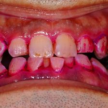 バイオフィルムの存在を・・・