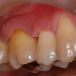 ぺリオウェーブの効果