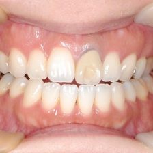 毎年ですが・・・夏はやっぱりホワイトニングでね!