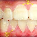 バイオフィルムプラーク