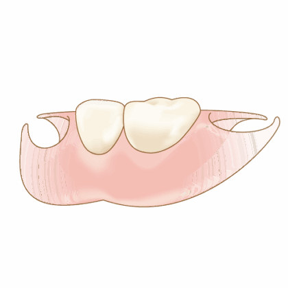 ノンクラスプデンチャー