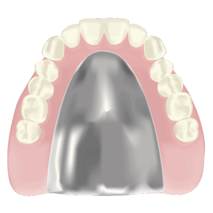 金属床義歯
