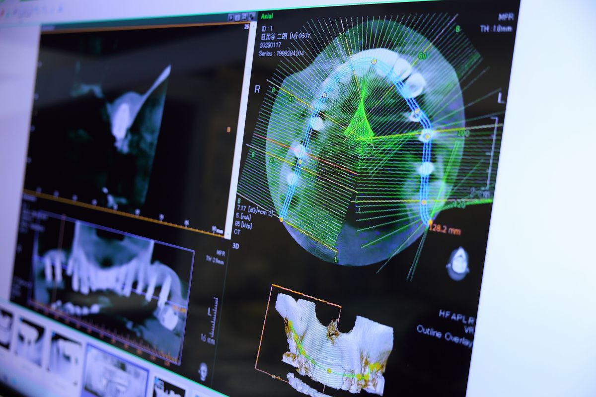CTとサージカルガイドで、より安全・正確なインプラント治療を