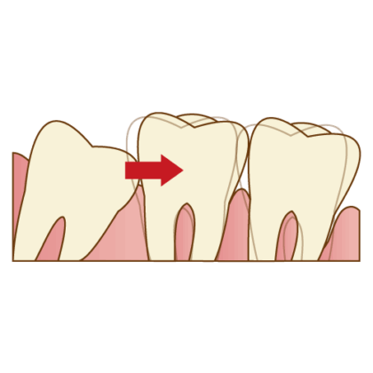 隣の歯を圧迫している
