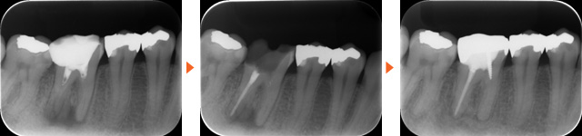根管治療の治療法