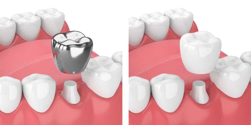 銀歯を白くするか検討している方へ